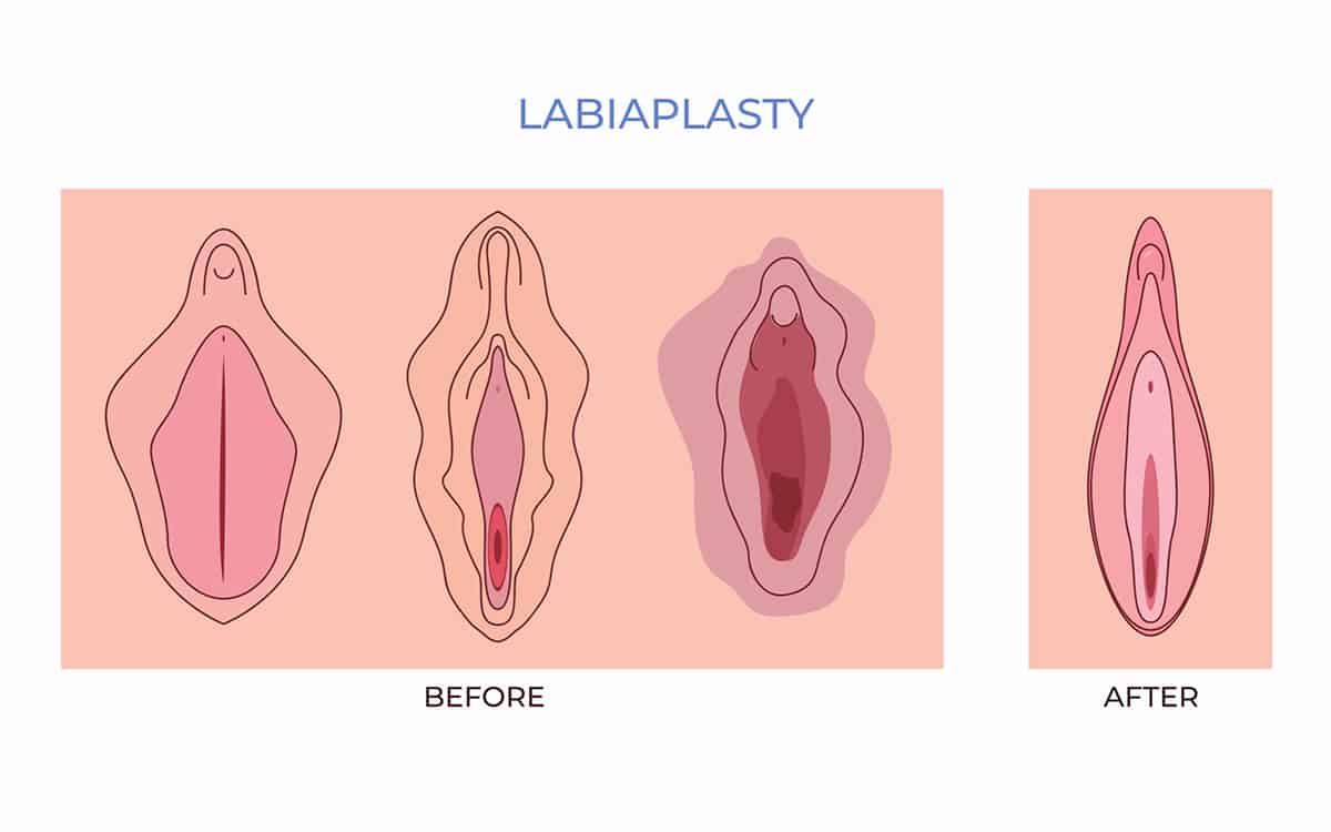 Labiaplasty procedure West Palm Beach