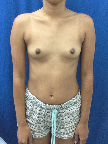 Before Image: Breast Augmentation - front