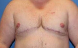 After Image: FTM Top Surgery - front