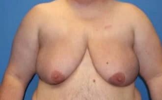 Before Image: FTM Top Surgery - front