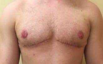After Image: FTM Top Surgery - front