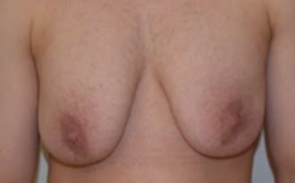 Before Image: FTM Top Surgery - front
