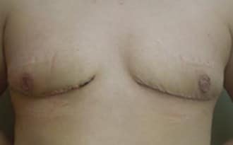 After Image: FTM Top Surgery - front