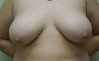 Before Image: FTM Top Surgery - front