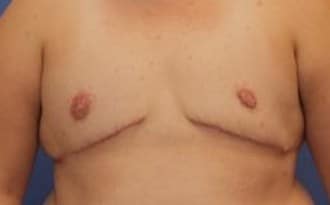 After Image: FTM Top Surgery - front
