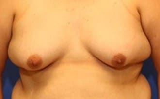 Before Image: FTM Top Surgery - front