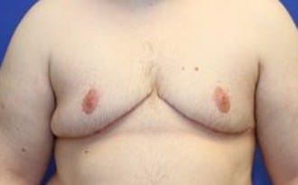 After Image: FTM Top Surgery - front