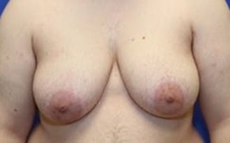 Before Image: FTM Top Surgery - front