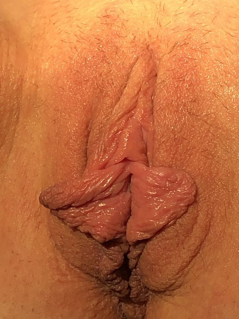 Before Image: Labiaplasty - front