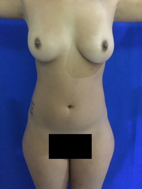 Before Image: Liposuction with Breast Augmentation and Butt Lift - front