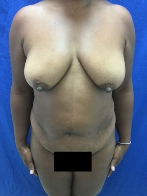 Before Image: Mommy Makeover - front