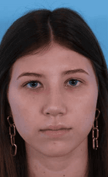 After Image: Rhinoplasty - front