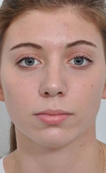After Image: Rhinoplasty - front