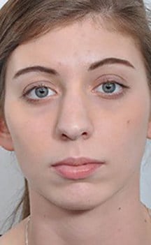 Before Image: Rhinoplasty - front
