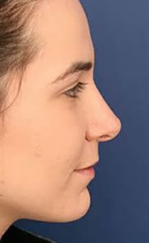 After Image: Rhinoplasty - right-side