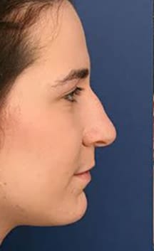 Before Image: Rhinoplasty - right-side