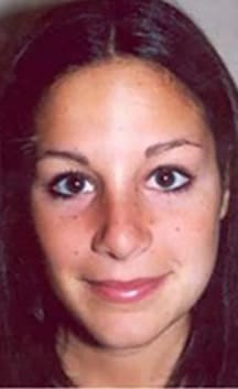 After Image: Rhinoplasty - front