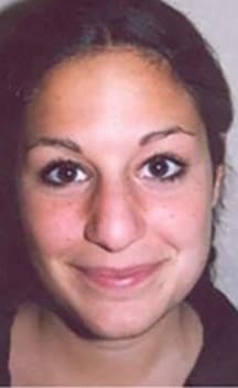 Before Image: Rhinoplasty - front