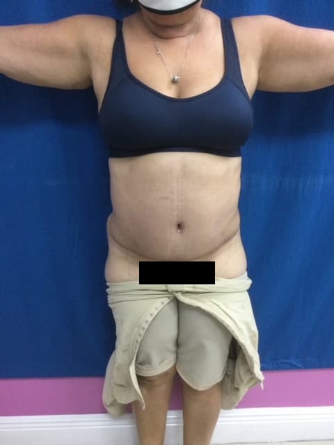 After Image: Tummy Tuck & Liposuction - front