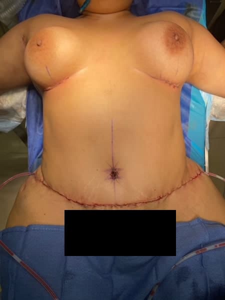 After Image: Tummy Tuck - front
