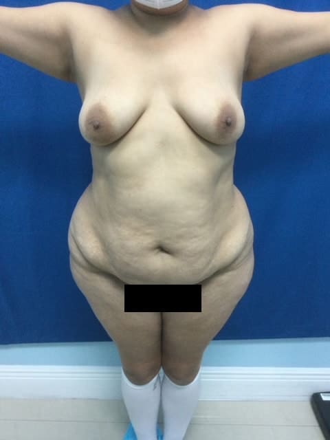 Before Image: Tummy Tuck - front